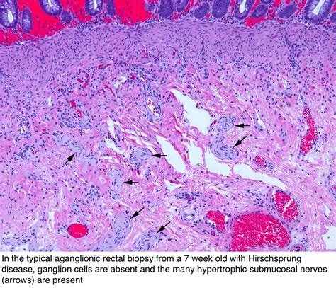 Pathology Outlines - Hirschsprung disease