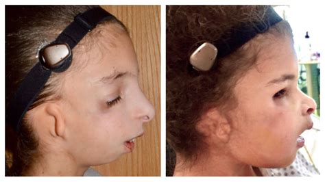 craniofacial treatment and services | Dayton Children's