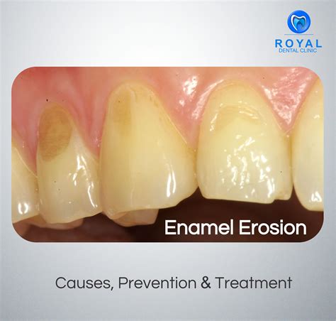 Enamel Erosion Signs Causes And Treatment Gentle Dent - vrogue.co