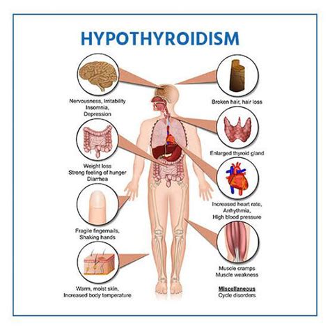 Treatment of underactive thyroid - MEDizzy