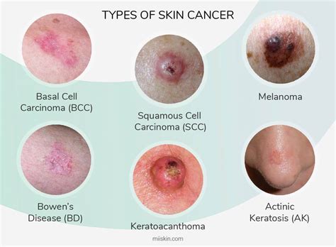 Suncity Skin Cancer Clinic | Geraldton WA