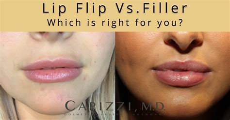 Lip flip or lip filler — which is right for you? - Capizzi MD