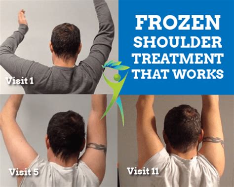 Frozen Shoulder Treatment That Works [Video Case Study]