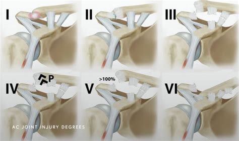 AC Joint Injury Chicago, IL | Dr. Jorge Chahla