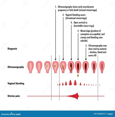 Miscarriage Royalty-Free Illustration | CartoonDealer.com #71138568