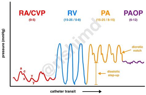 Google Image Result for https://rk.md/wp-content/uploads/2020/04/pa-catheter-waveforms-labeled ...