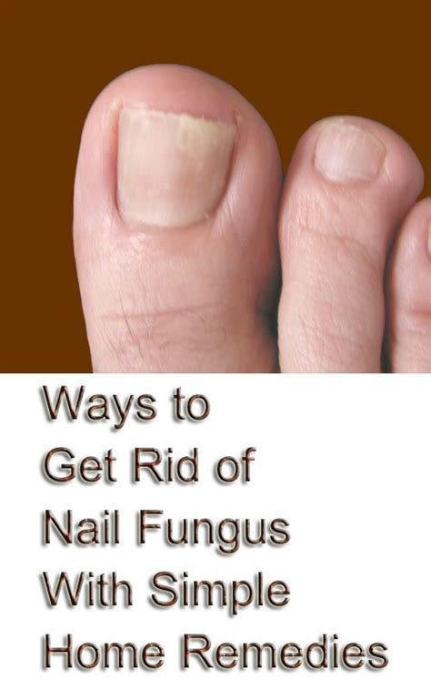 14 Simple Home Remedies to Get Rid of Toe Nail Fungus | Natural home remedies, Nail fungus, Remedies