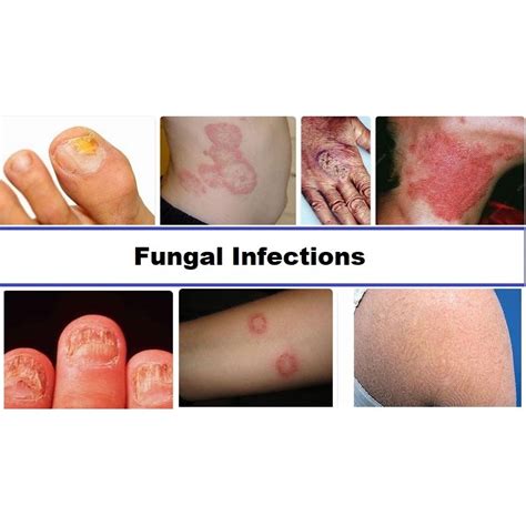 New Fungal Infection 2024 - Thia Sharia