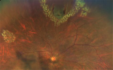 Retinal Tear | Brisbane Ophthalmologist & Retina Treatment