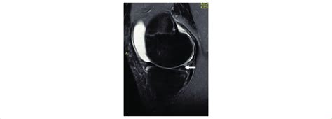 A-C. Acute ACL tear in a 23-year old female basketball player. A ...