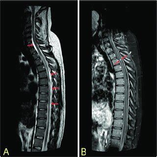 Brain MRI. T1 weighted MRI scans of the brain with contrast in axial ...