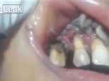 Wriggling maggots in a patient's mouth in Brazil | Daily Mail Online