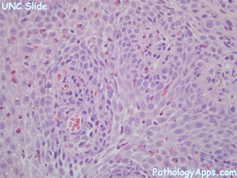 eosinophilic esophagitis pathology