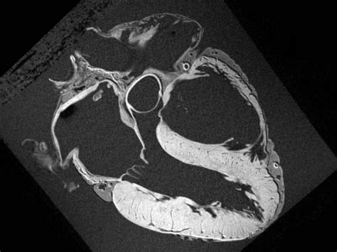 G : ' heart mri scan' | Mri scan, Cardiac, Human heart