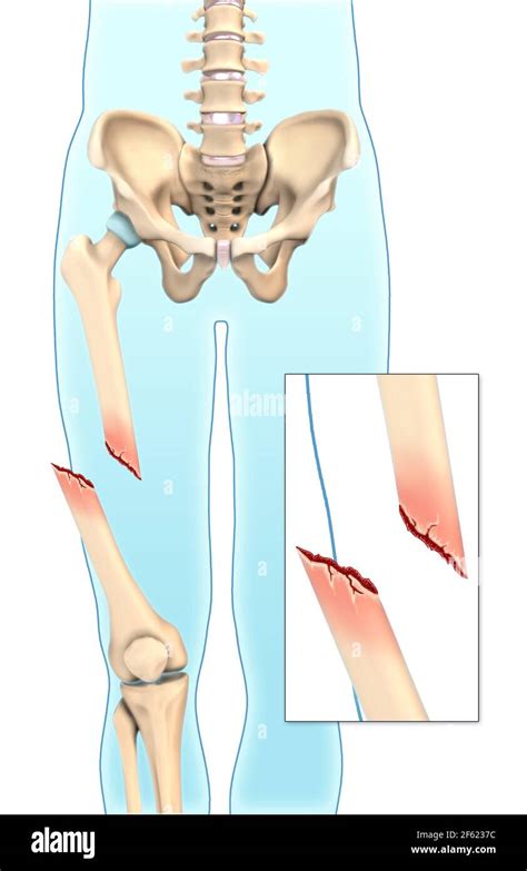 Compound Fracture X Ray