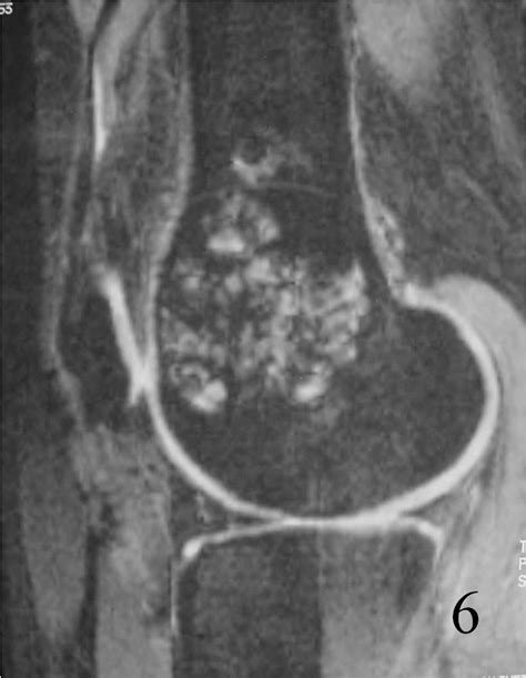 Giant Cell Tumor of Bone: Bone Tumors