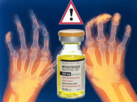 Rheumatoid arthritis drug : methotrexate may elevate a risk of a ...