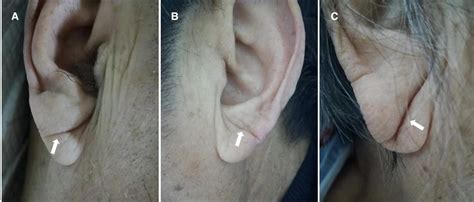 Frontiers | The prognostic value of deep earlobe creases in patients ...