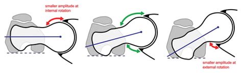 Femoral Antetorsion: Comparing Asymptomatic Volunteers and Patients with Femoroacetabular ...