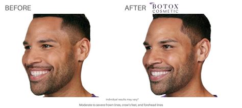 Botox Before and After | Real Results from Real Patients