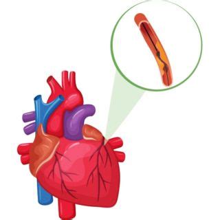 What Are the Risks of Coronary Angiography? | Dr Raghu