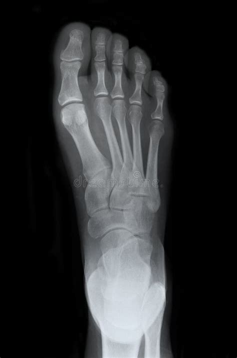 Right Foot Top Xray Royalty Free Stock Photos - Image: 23575678