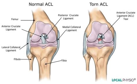 A Guide to ACL and MCL Injuries - GaiaGuides.com