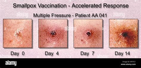 Smallpox Stages