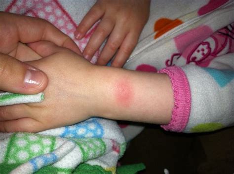 SPIDER BITE?! | BabyCenter