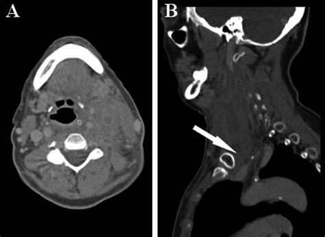 Resection for Internal Jugular Vein Thrombosis and Cervical Lymph Nodes' Involvement from ...