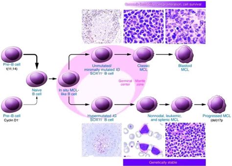 Mantle cell lymphoma symptoms, diagnosis, prognosis and treatment