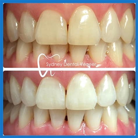 Teeth bleaching | sydneydentalveneer.com.au