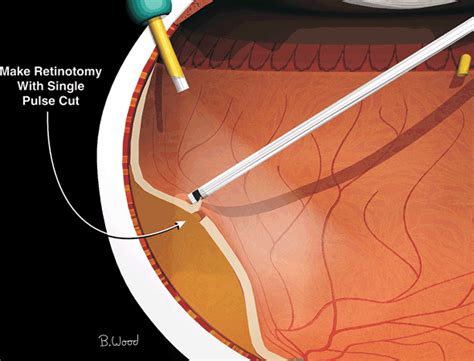 Vitrectomy for Retinal Detachment | Ento Key