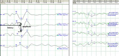 Left : visual evoked potential (VEP) with latency and amplitude marked.... | Download Scientific ...