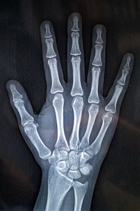 Skeleton Hand X Ray | sexiezpix Web Porn