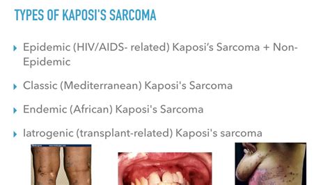 Kaposi's Sarcoma: An Overview - YouTube