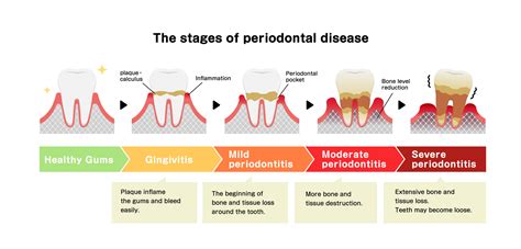 What Damage Can Periodontal Disease Cause? | Arizona Periodontal Group