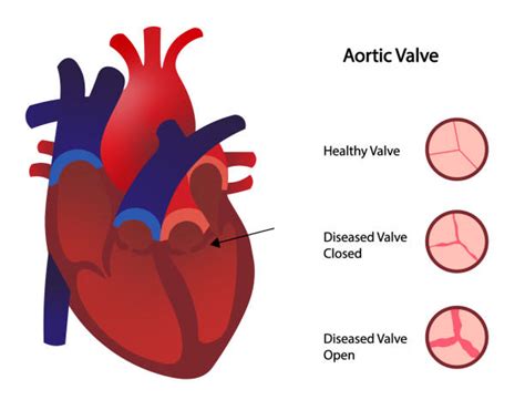 Aortic Semilunar Valve Stock Photos, Pictures & Royalty-Free Images ...