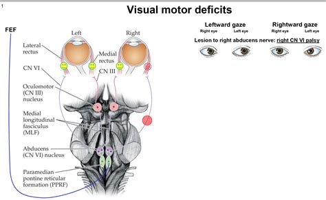 Image result for right abducens right mlf lesion | Abducens nerve, Mind ...