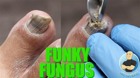 Toenail Fungus Drill Hole - Nail Ftempo