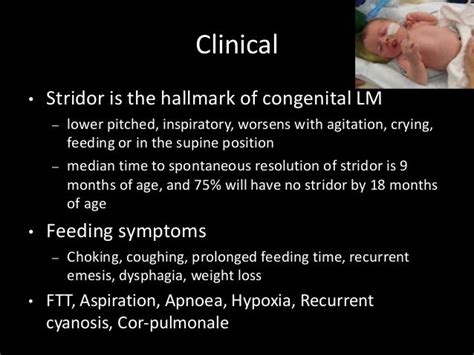 Laryngomalacia