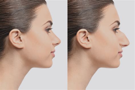 RHINOPLASTY - Garza Plastic Surgery - Nashville, TN