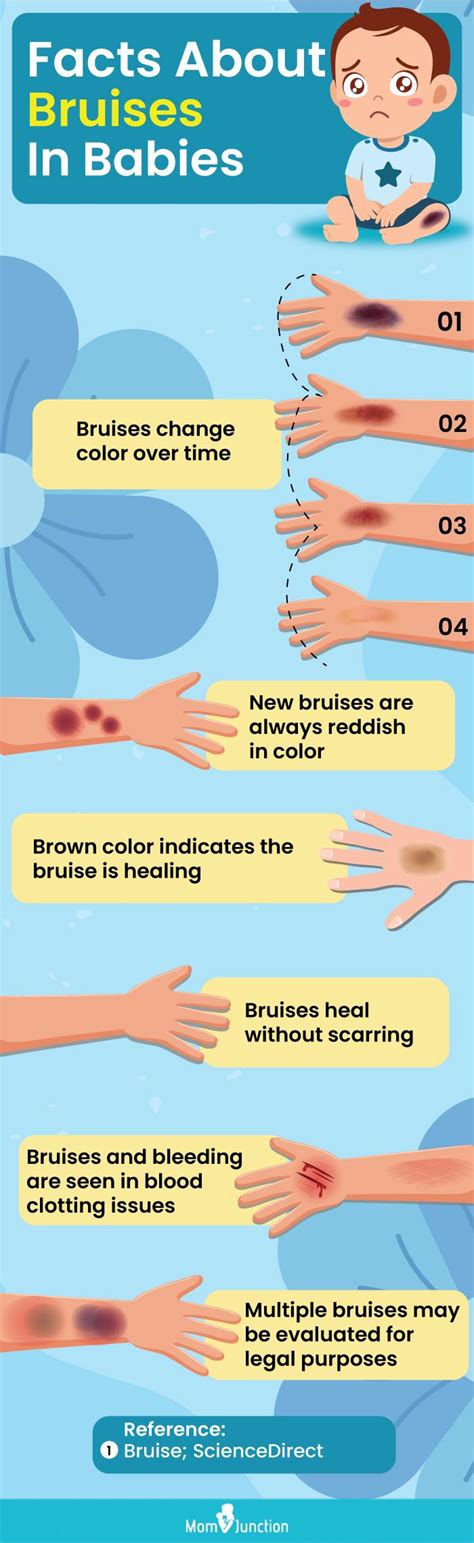 Leukemia Symptoms Bruising