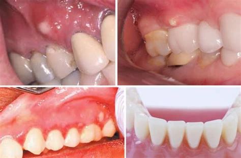 White Spots on Gums- Baby, Painful, Pictures, Above, Below Teeth, Hard, Causes & How to Get Rid