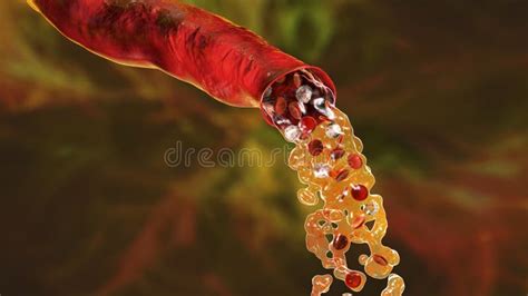 Blood flow, hemorrhage stock illustration. Illustration of ...