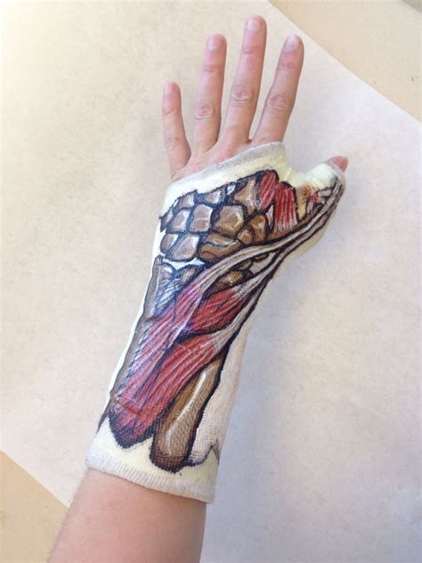 One of my friends had surgery on his hand and hand painted an exact replica of… | Cast designs ...