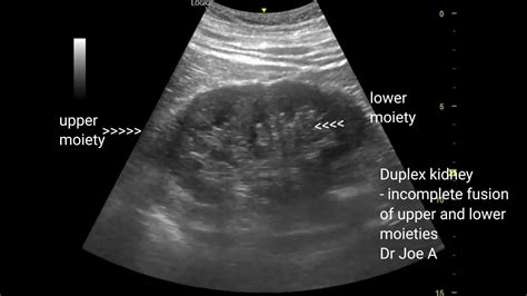 Duplex kidney or bifid renal pelvis or duplication of collecting system ultrasound video - YouTube