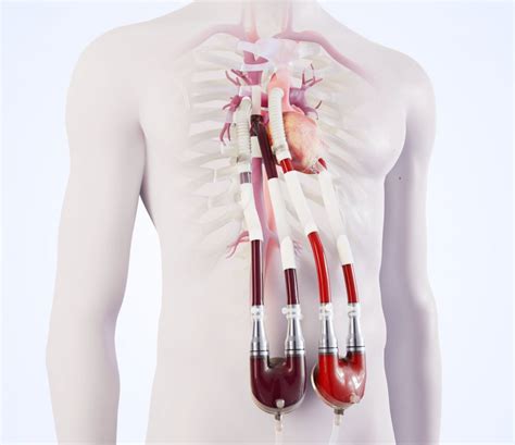 New circulation implant to bridge the waiting time for donor heart ...