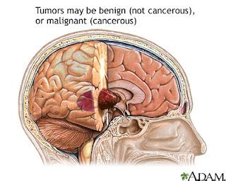 A Stock Photos: brain tumor stages