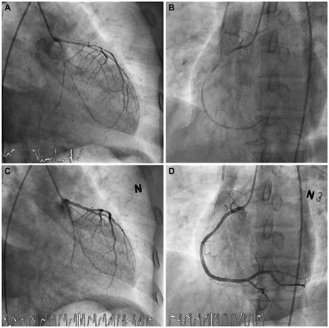 Results of coronary angiogram. A and B: coronary angiogram showing... | Download Scientific Diagram